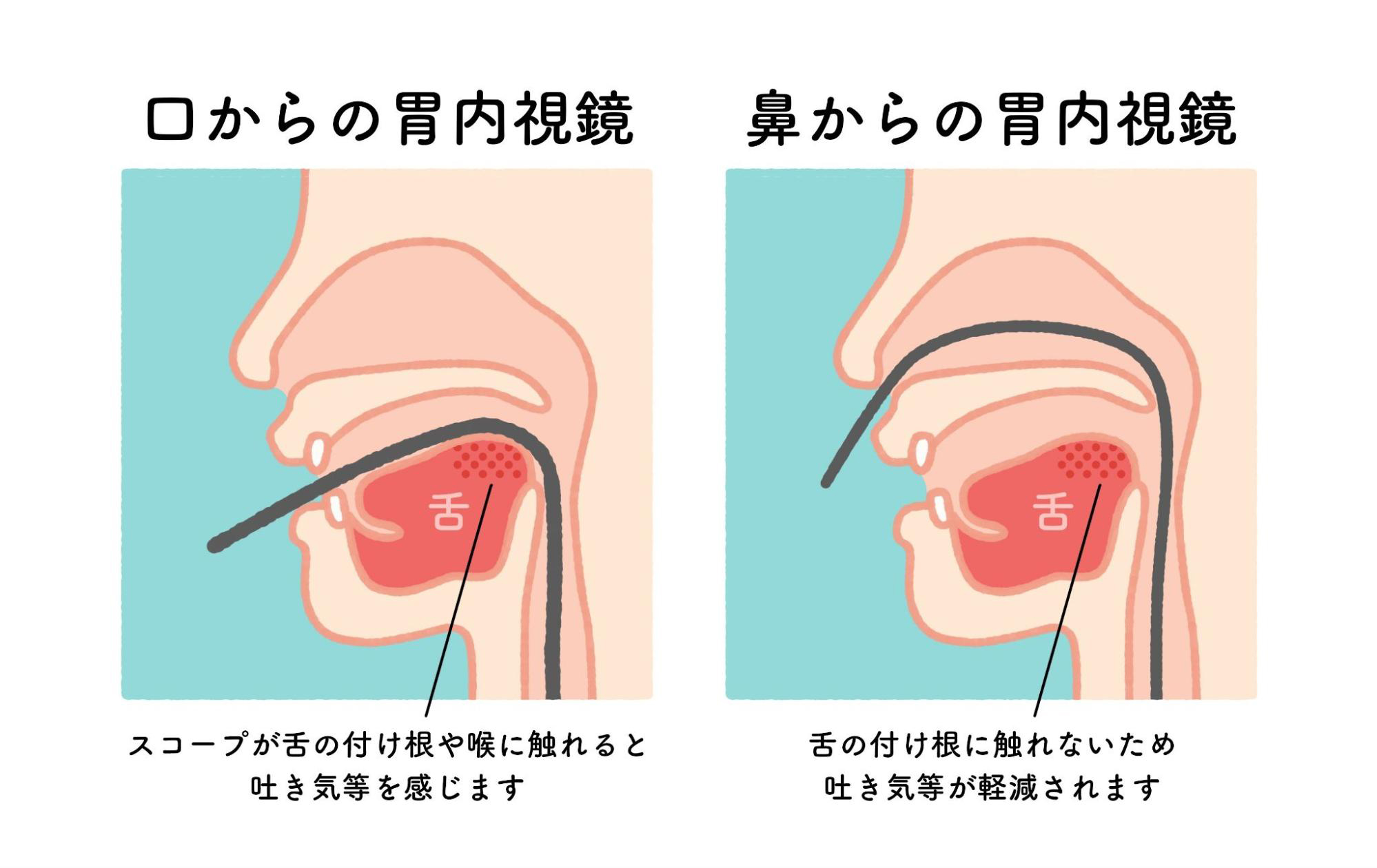 胃カメラ検査とは？使用する内視鏡の種類